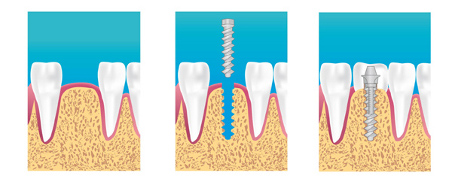 implants dentaires marseille 13003 13015 13002